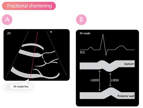 ejection fraction vs fractional shortening.